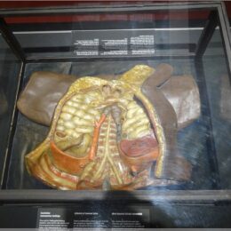 Bauchsitus siamesischer Zwillinge